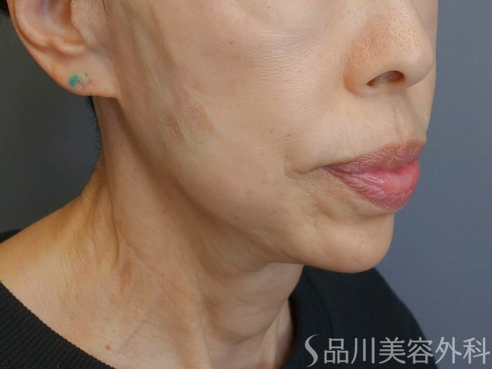 症例NO.72641のAFTER写真