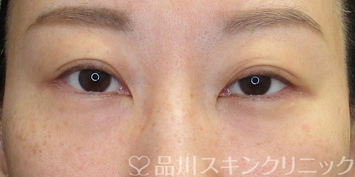 症例NO.73465のBEFORE写真