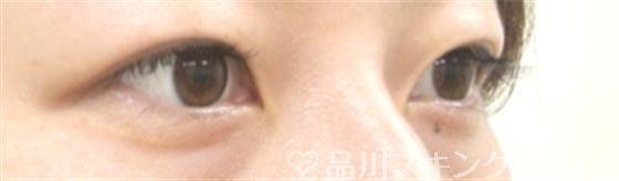 症例NO.30130のAFTER写真
