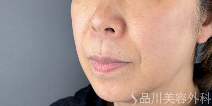症例NO.69282のBEFORE写真