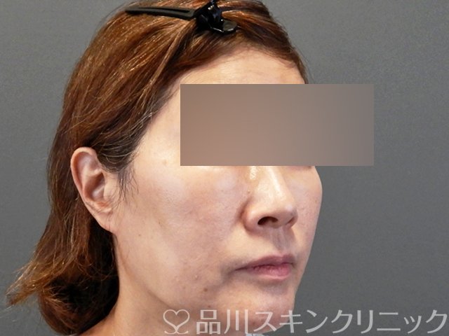 症例NO.66270のBEFORE写真