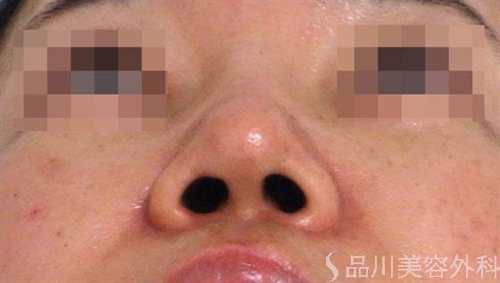 症例NO.36508のAFTER写真