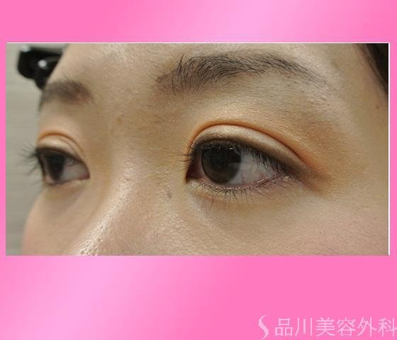 症例NO.14605のAFTER写真