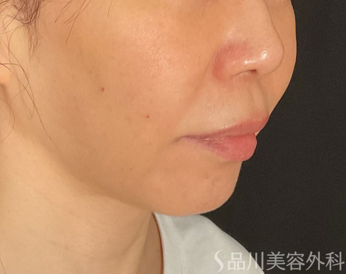 症例NO.75209のBEFORE写真