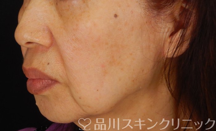 症例NO.65135のBEFORE写真