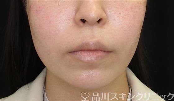 症例NO.58842のBEFORE写真