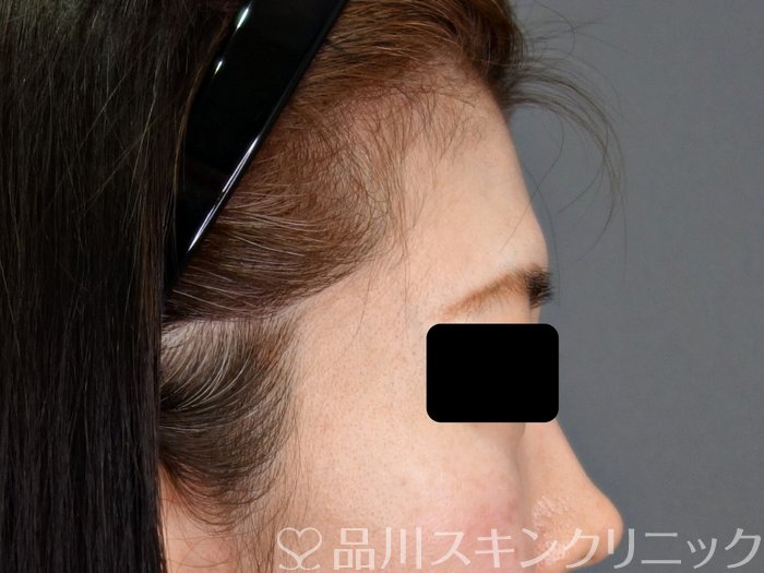 症例NO.73342のBEFORE写真