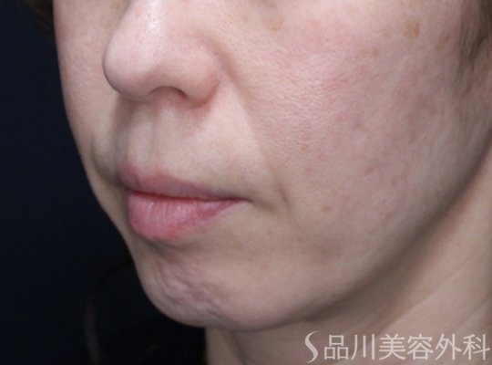 症例NO.73558のBEFORE写真