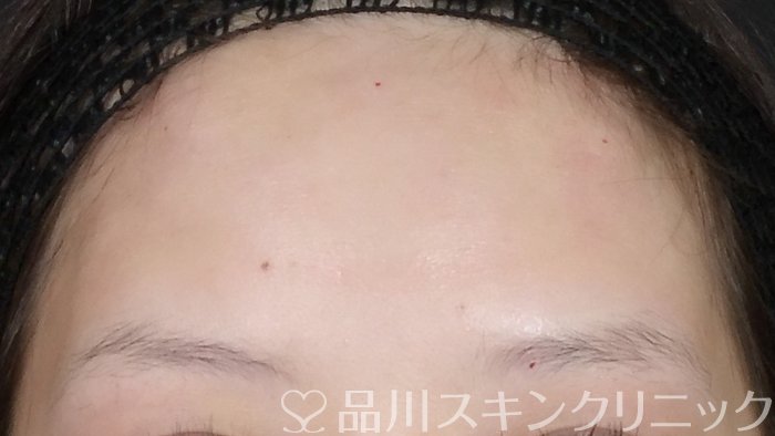 症例NO.72331のAFTER写真