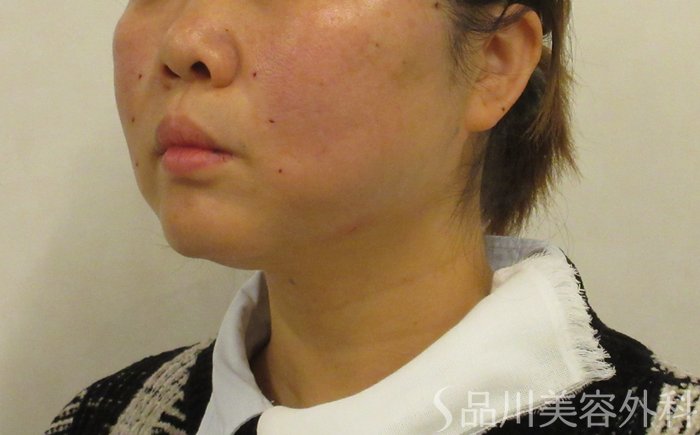 症例NO.72202のAFTER写真