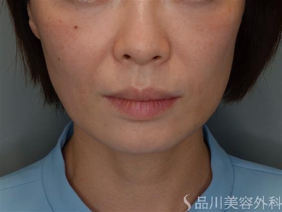 症例NO.51087のBEFORE写真