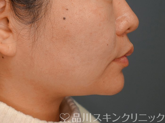 症例NO.73773のBEFORE写真