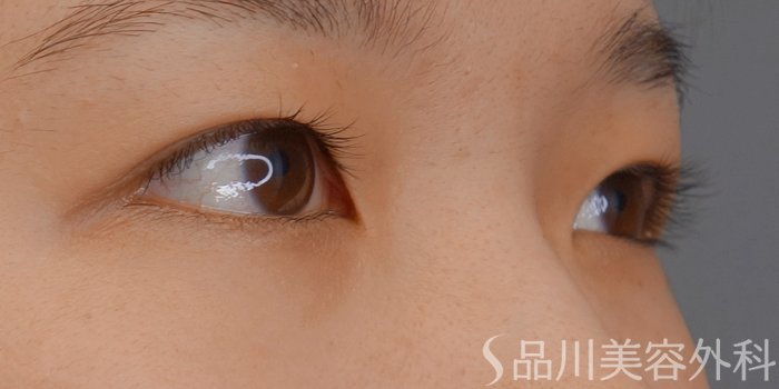 症例NO.70026のBEFORE写真