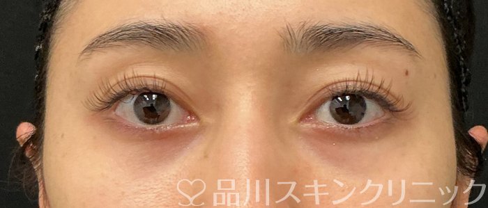 症例NO.74155のBEFORE写真
