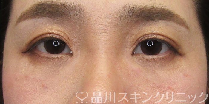症例NO.75173のAFTER写真