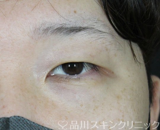 症例NO.62165のBEFORE写真