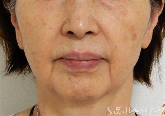 症例NO.39897のBEFORE写真