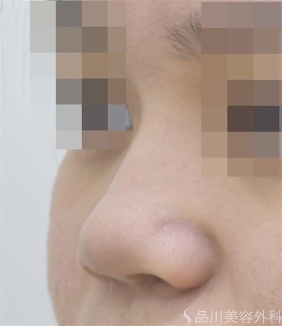 症例NO.46180のBEFORE写真