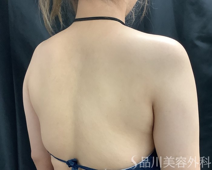 症例NO.67993のBEFORE写真