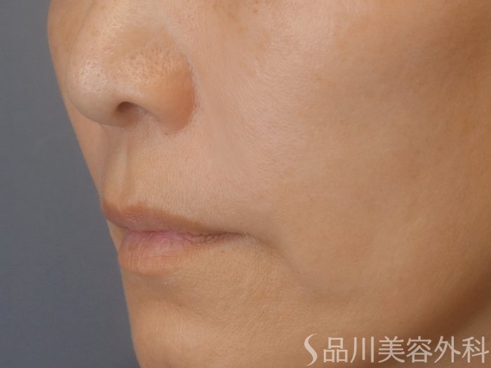 症例NO.72488のAFTER写真