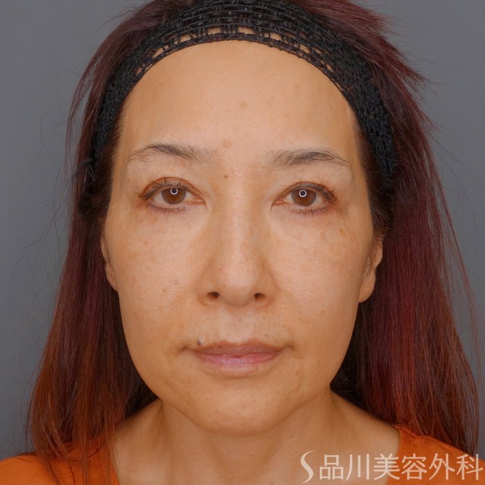 症例NO.62369のBEFORE写真