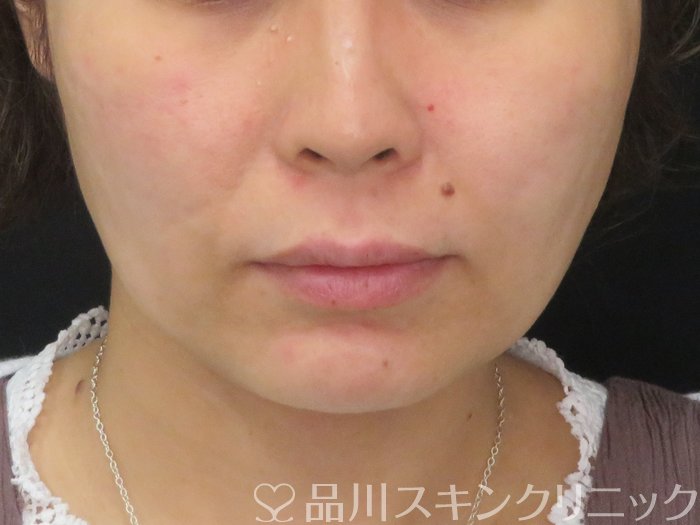 症例NO.74784のAFTER写真