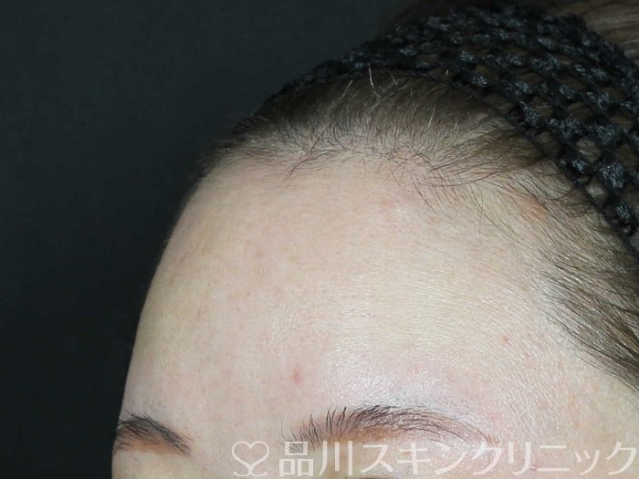 症例NO.70235のBEFORE写真