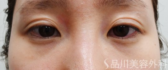 症例NO.70161のBEFORE写真