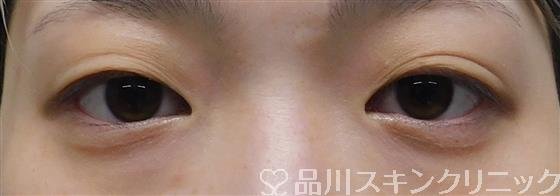 症例NO.51798のBEFORE写真