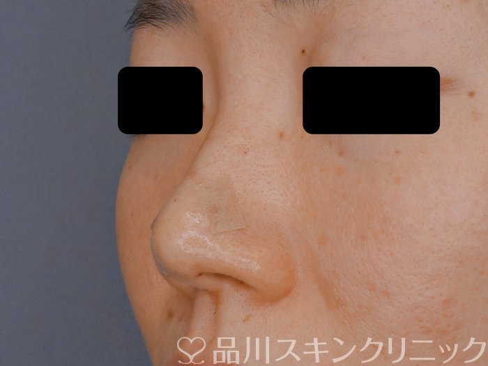 症例NO.71574のAFTER写真