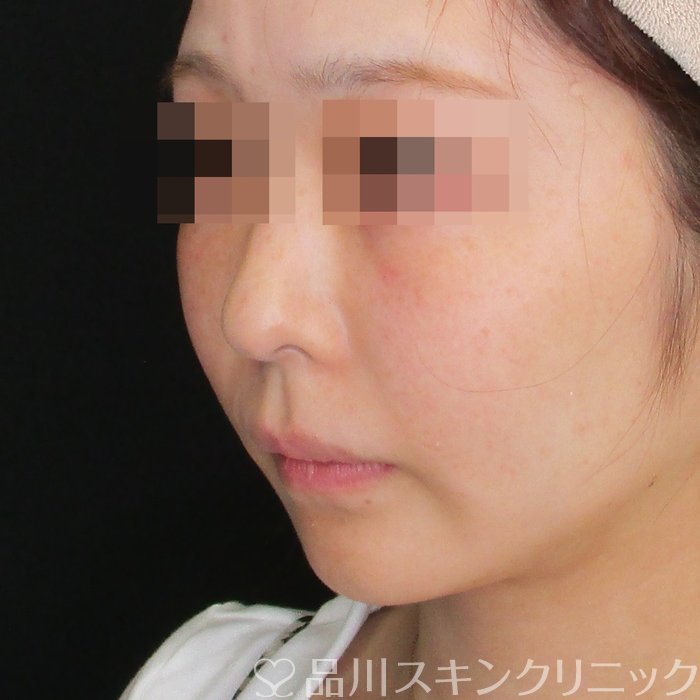 症例NO.75034のAFTER写真