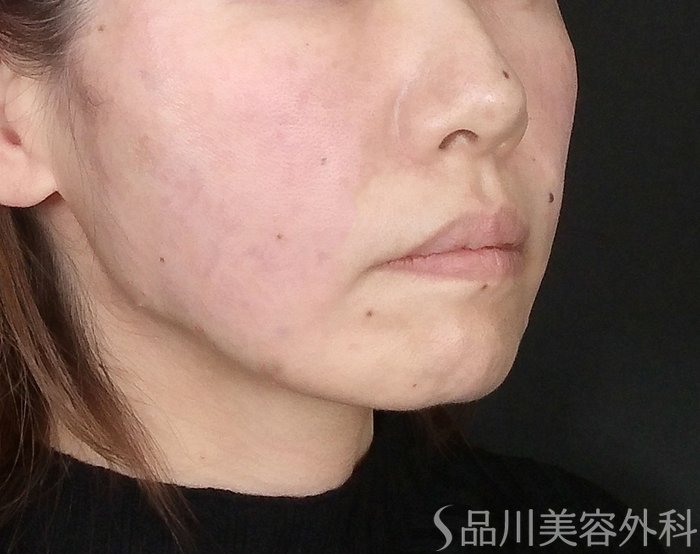 症例NO.69646のAFTER写真