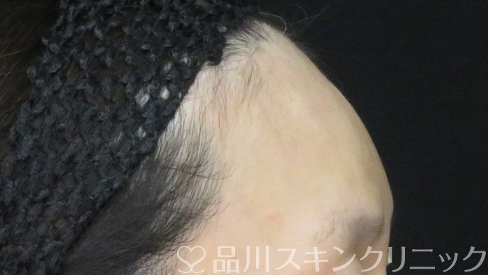 症例NO.71901のAFTER写真