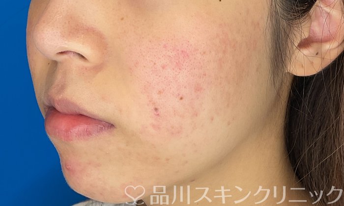 症例NO.72788のAFTER写真