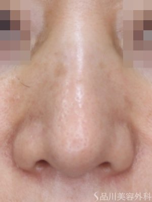 症例NO.75100のBEFORE写真