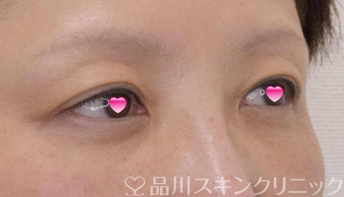 症例NO.74272のAFTER写真