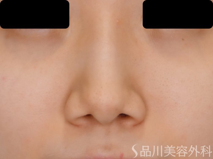 症例NO.70116のBEFORE写真