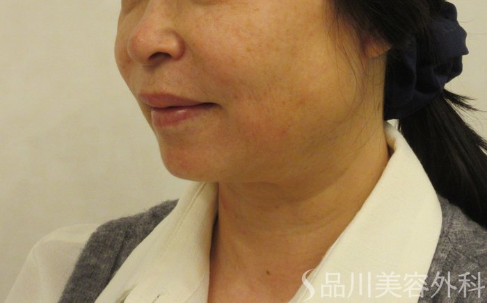 症例NO.72426のBEFORE写真