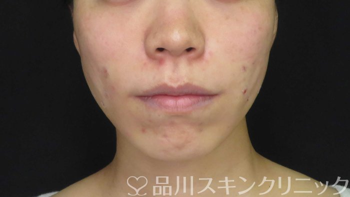 症例NO.72953のAFTER写真