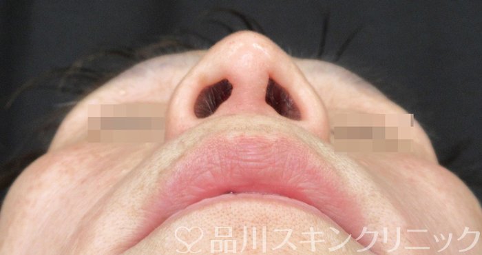 症例NO.65370のAFTER写真