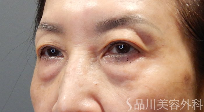 症例NO.71187のBEFORE写真
