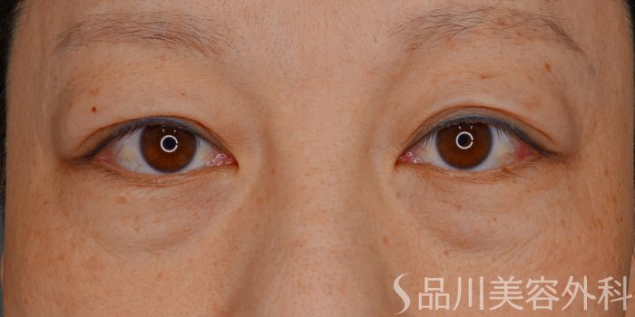 症例NO.73725のBEFORE写真