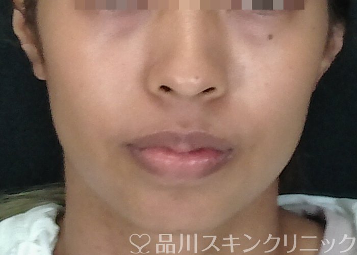症例NO.70921のBEFORE写真