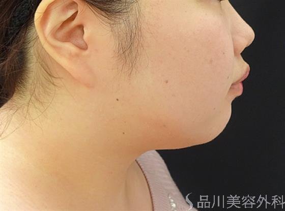 症例NO.40591のAFTER写真