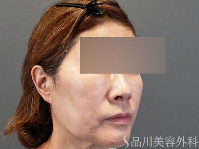 症例NO.66270のBEFORE写真