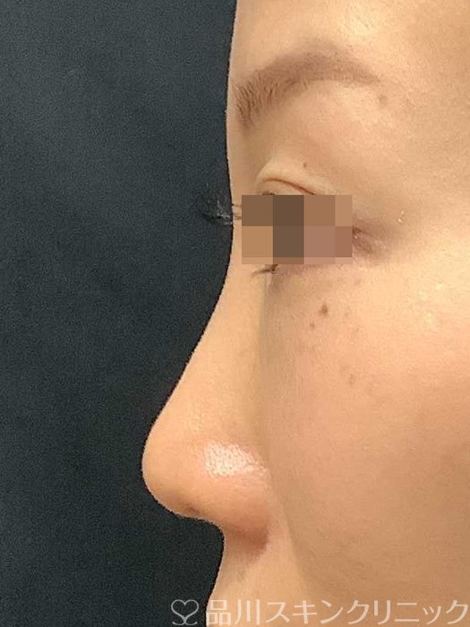 症例NO.69703のBEFORE写真