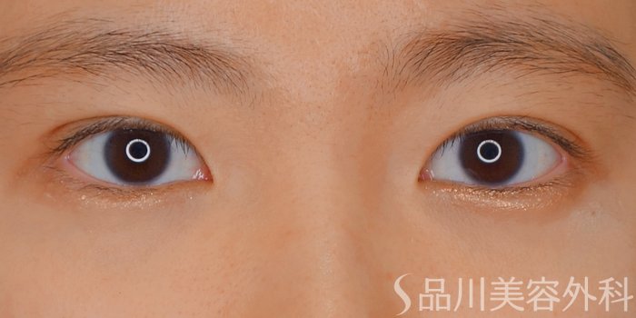 症例NO.70523のAFTER写真