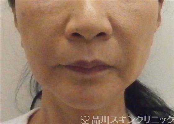 症例NO.35599のBEFORE写真