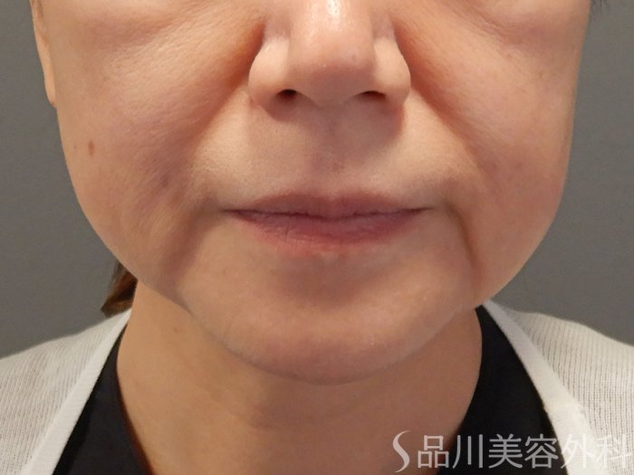 症例NO.71112のBEFORE写真