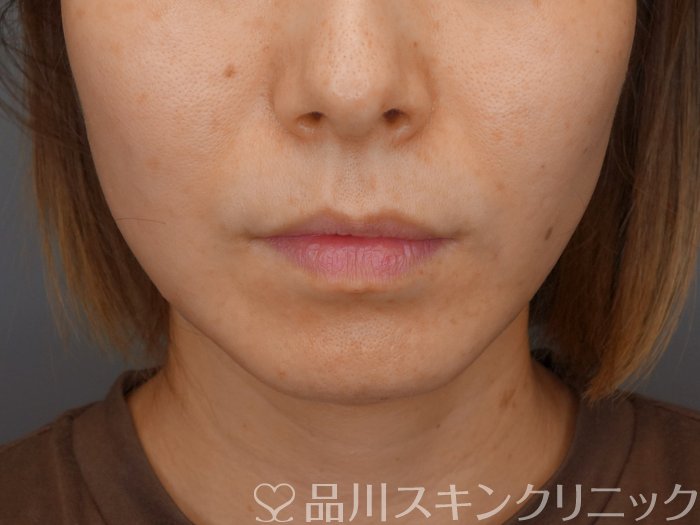 症例NO.70865のAFTER写真